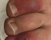المصري اليوم - تكنولوجيا - «أصابع كوفيد».. أعراض جلدية تظهر على المصابين بفيروس كورونا موجز نيوز