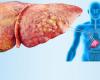 مرض الكبد الدهني وخطورتة